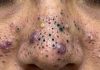 Cystic Blackheads Extraction