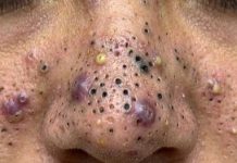 Cystic Blackheads Extraction