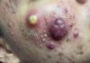 Big Cystic Blackheads Extraction