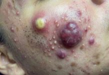 Big Cystic Blackheads Extraction