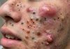Big Cystic Blackheads Extraction