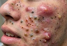 Big Cystic Blackheads Extraction