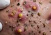 Blackheads Extraction Blackheads