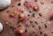Blackheads Extraction Blackheads