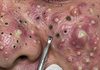 Acne Blackheads Extraction Removal