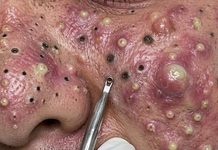 Acne Blackheads Extraction Removal