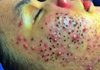 Acne Blackheads Extraction