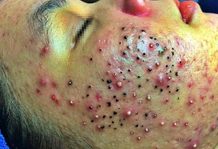 Acne Blackheads Extraction