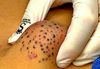 Big Cystic Blackheads Extraction
