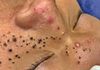 Acne Blackheads Extraction