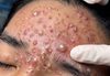 Acne Blackheads Extraction Whiteheads