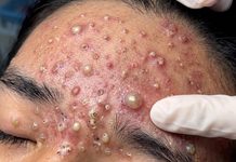 Acne Blackheads Extraction Whiteheads