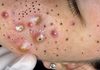Acne Blackheads Extraction Whiteheads