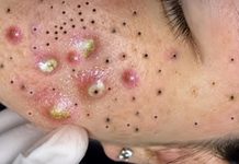 Acne Blackheads Extraction Whiteheads