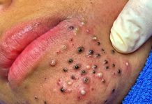 Blackheads Extraction Whiteheads