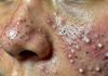 Acne Blackheads Extraction