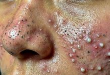 Acne Blackheads Extraction