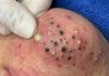 Blackheads Extraction Whiteheads