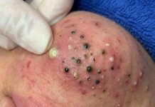 Blackheads Extraction Whiteheads