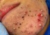 Blackheads Extraction Whiteheads