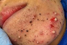 Blackheads Extraction Whiteheads
