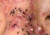 Cystic Blackheads Extraction Whiteheads