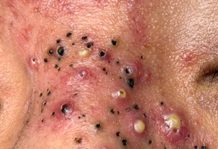 Cystic Blackheads Extraction Whiteheads