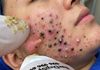 Acne Blackheads Extraction