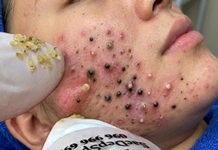 Acne Blackheads Extraction