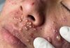 Acne Blackheads Extraction Whiteheads