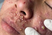Acne Blackheads Extraction Whiteheads