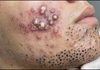 Acne Blackheads Extraction Whiteheads