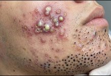 Acne Blackheads Extraction Whiteheads