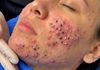 Acne Blackheads Extraction