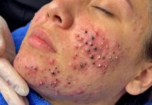 Acne Blackheads Extraction
