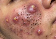 Big Cystic Blackheads Extraction