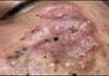 Acne Blackheads Extraction