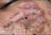 Acne Blackheads Extraction