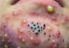 Blackheads Extraction Whiteheads