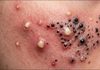 Acne Blackheads Extraction
