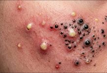 Acne Blackheads Extraction