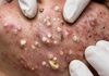 Acne Blackheads Extraction Whiteheads