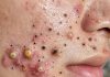 Acne Blackheads Extraction