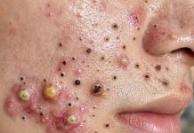 Acne Blackheads Extraction