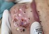 Blackheads Extraction