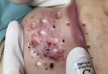 Blackheads Extraction