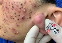 Big Cystic Blackheads Extraction