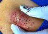 Blackheads Extraction Blackheads
