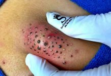 Blackheads Extraction Blackheads