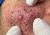 Acne Blackheads Extraction